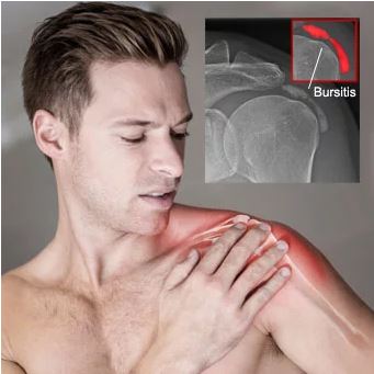 Shoulder Bursitis Pain, Symptoms, Treatment
