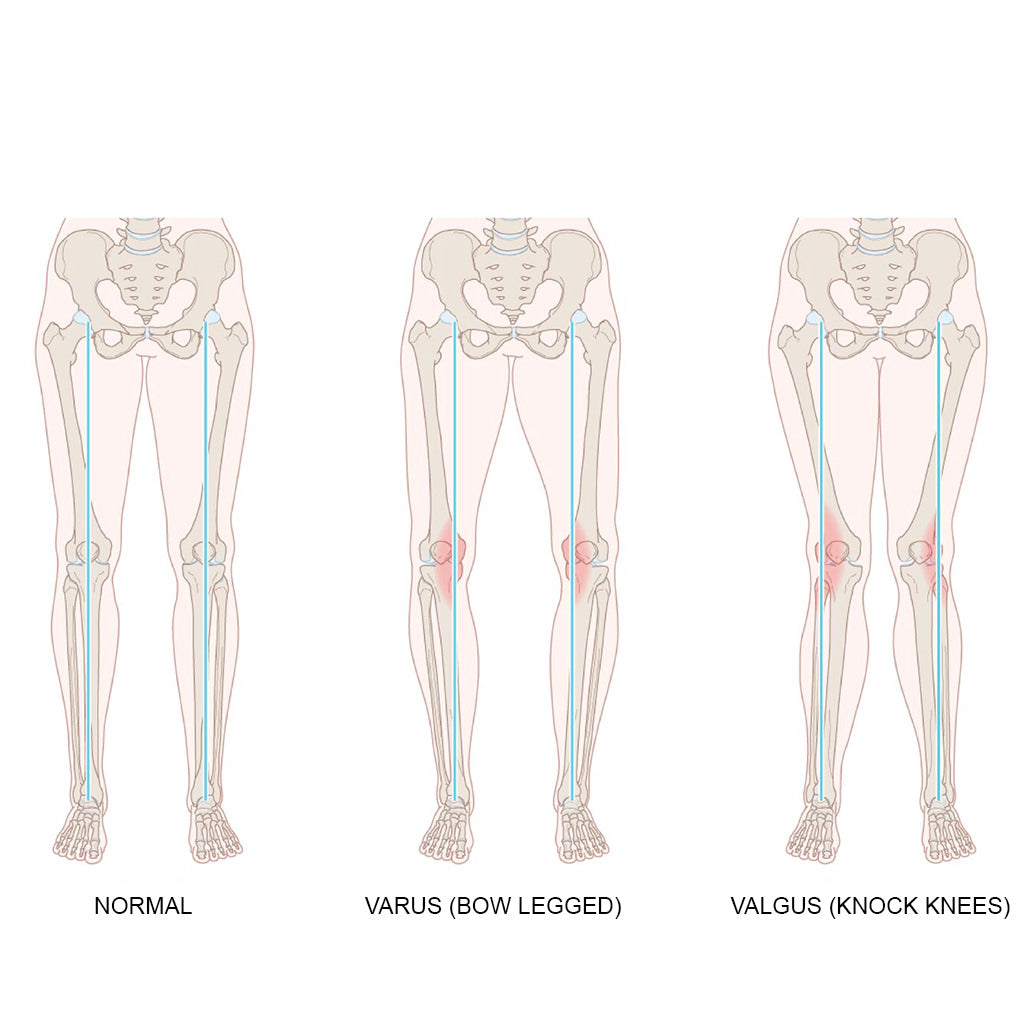 neoprene-knee-support-right-varus-left-valgus-8